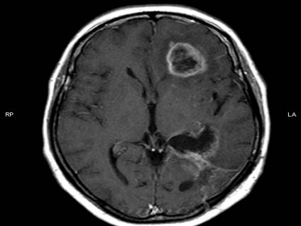 Beyin tümöründe mutlaka dikkate alınması gereken belirtiler nelerdir?
