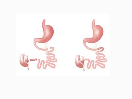 İleal interpozisyon ameliyatı hangi diyabet hastalarına uygulanabilir?