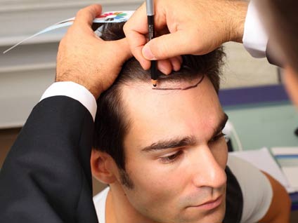 Saç nakli özgüveni artırır mı?