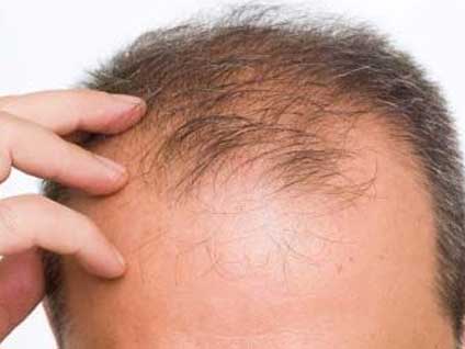 Saç dökülmesinin 20'li yaşlarda görülmeye başlamasının nedenleri nelerdir?