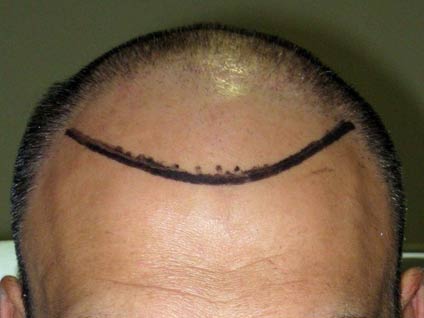 Saç naklinin aşamaları nelerdir?