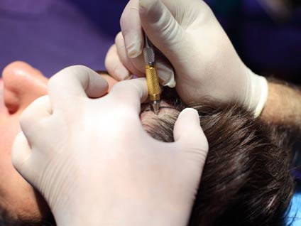 Saç naklinde uygulanan kaç teknik vardır?