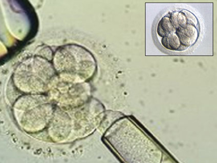 Erkek kısırlığında hangi durumlarda tüp bebek tedavisi gerekir?