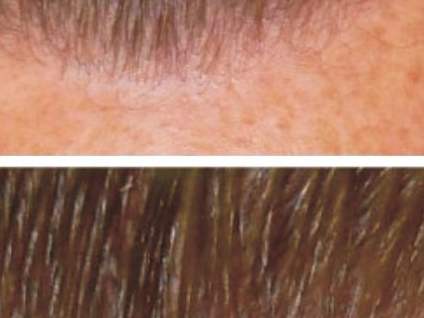 Saç nakli uygulamalarında son trend nedir?