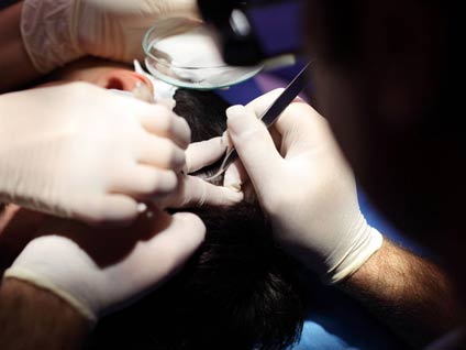 Saç naklinde son yıllardaki gelişmeler neler?