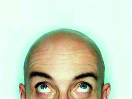 Saç nakline en uygun profili kimler oluşturur?