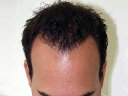 Saç, nakilden ne kadar süre sonra çıkmaya başlar?