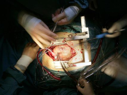 Kalp naklinde artış var mı?