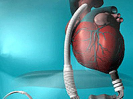 SGK kalp nakli ve yapay kalp nakil sistemlerini karşılıyor mu?