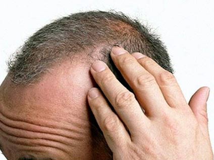 Türkiye'de saç nakli diğer ülkelere göre ne durumda?