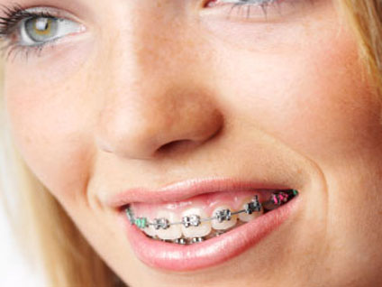 Diş teli çürüğe yol açar mı? Plak kullanmanın faydaları neler?