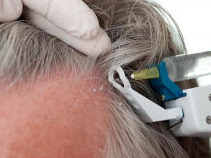 Saç mezoterapisi nedir? Tedavi yöntemleri neler?