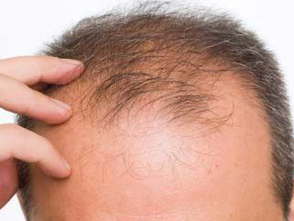 Ne tür beslenme şekli saç dökülmesine neden olur?