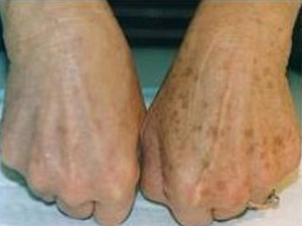 Ben düşmesi mümkün mü? Ellerde leke neden oluşur?