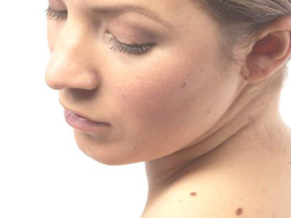 Cilt kanseri sadece benlerle mi ortaya çıkar?