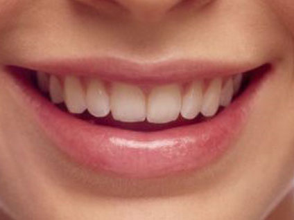 İmplant tedavisinin klasik yöntemden farkı nedir?