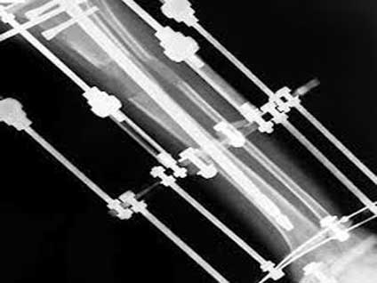 Kaynamamış kırıklar ile kemik deformitelerinin çözümü var mı?