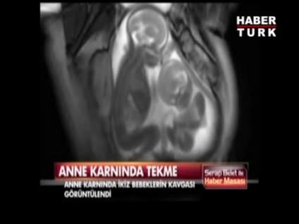 Anne karnında itişen ikizler!