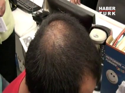 Kelliğe en çabuk çözüm!