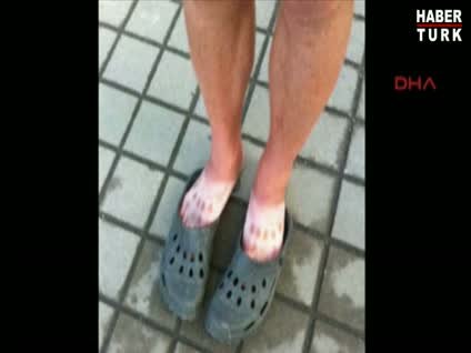 Güneş yanıkları güldürüyor