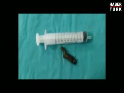 Gırtlağından canlı sülük çıkarıldı!