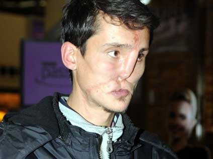 Ten uyumuna takılan Recep'e uygun yüz bulundu