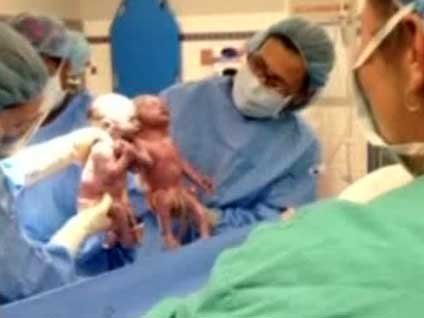 İkiz bebekler el ele dünyaya geldi