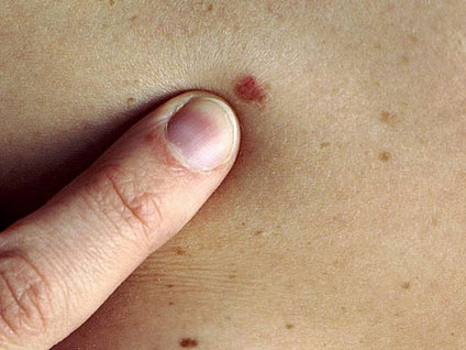 Benleriniz kanser habercisi mi?