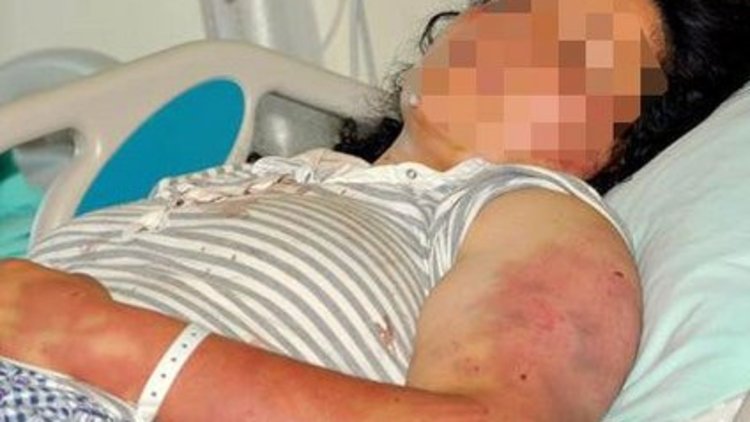 Kadına şiddet durmuyor, Giresun'da yine erkek şiddeti