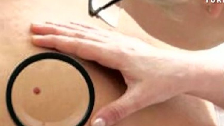 Ben sayısı cilt kanseri riskini gösteriyor