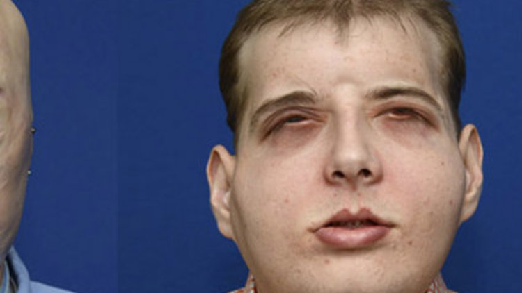 En kapsamlı yüz nakli yapıldı