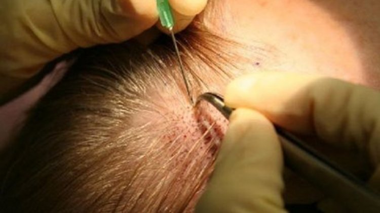 Türkiye&#039;de saç ektirenlerin sayısı artıyor. Peki saç ekiminin yan etkileri var mı?