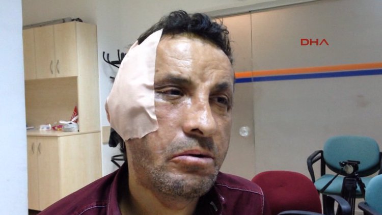 İlk yüz nakilli Uğur Acar'a, estetik müdahale