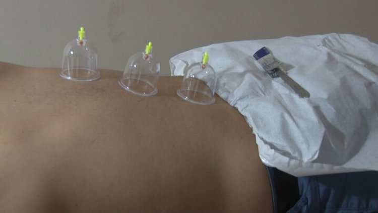 Tıp'ta 5 bin yıllık şifa Hacamat