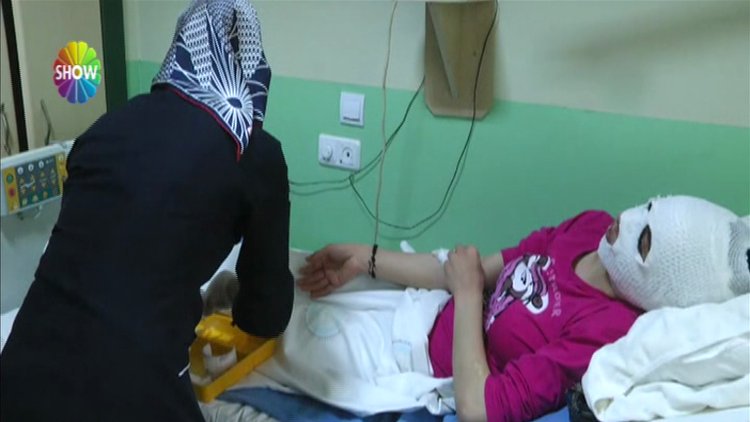 Düdüklü tencere patladı, yüzü yandı