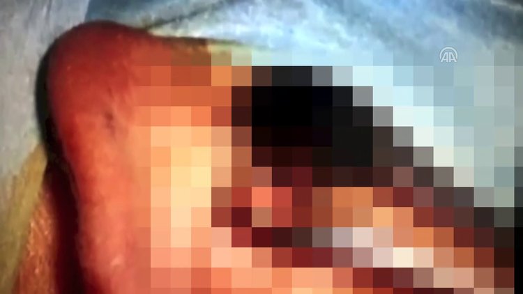 Çocuğun kulağından sinek larvaları çıktı