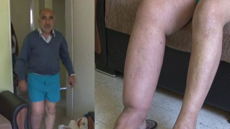 Fil hastası yaşlı adam çocuklarına bakabilmek için tedavi istiyor