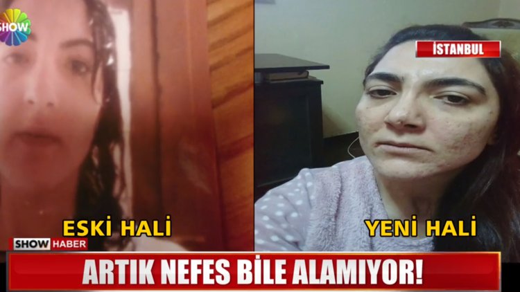 Güzelleşmek için ameliyat oldu yüzünden eser kalmadı!