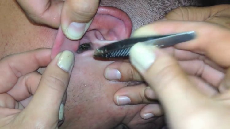 Kulağından böcek çıktı