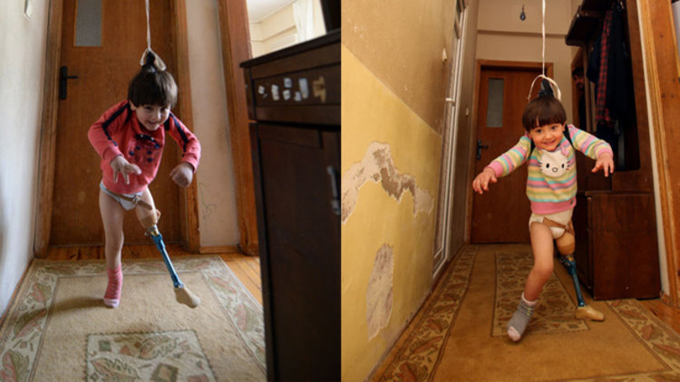 Protezle değil babasının 150 liralık düzeneğiyle yürüdü