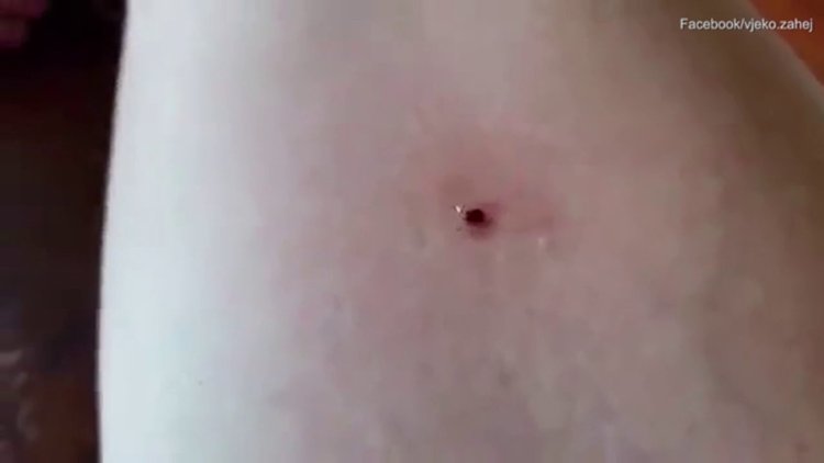 Vücudundaki keneyi nane yağı ile ayırdı