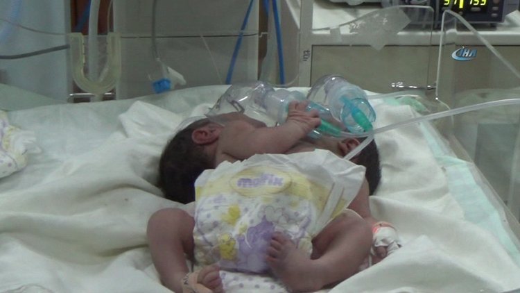 Suriye'de çift başlı bebek dünyaya geldi
