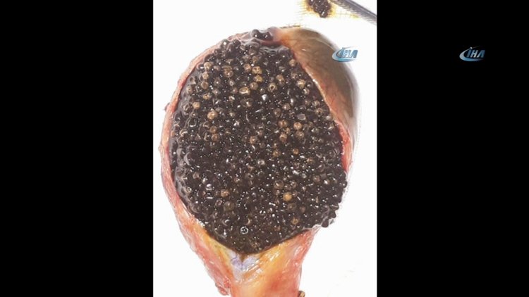 Safra kesesinden 3 bin 200 adet taş çıktı