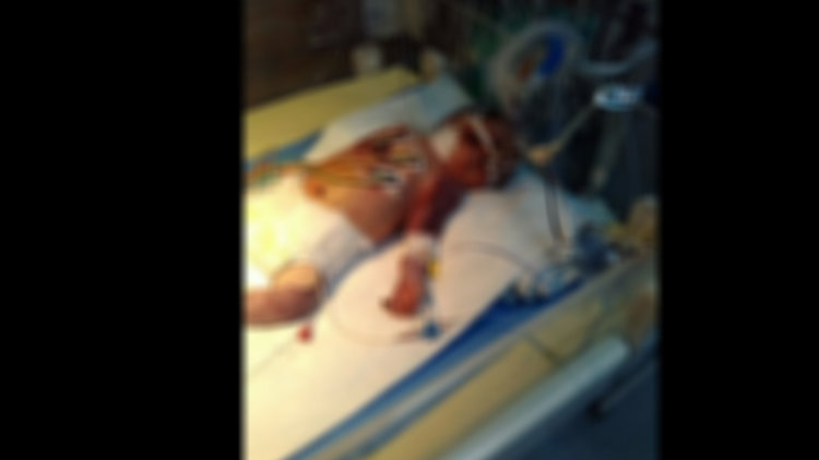 Minik bebeğin vücudu kuvözde morarıp şişmeye başladı