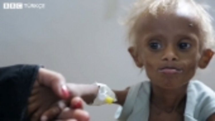 Yemen'deki insani krizin sembolü 7 yaşındaki Saleem