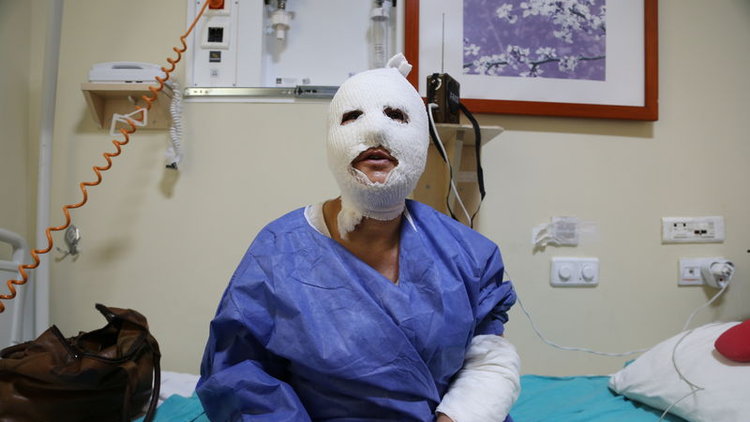 Erzurum'da patlayan düdüklü hastanelik etti