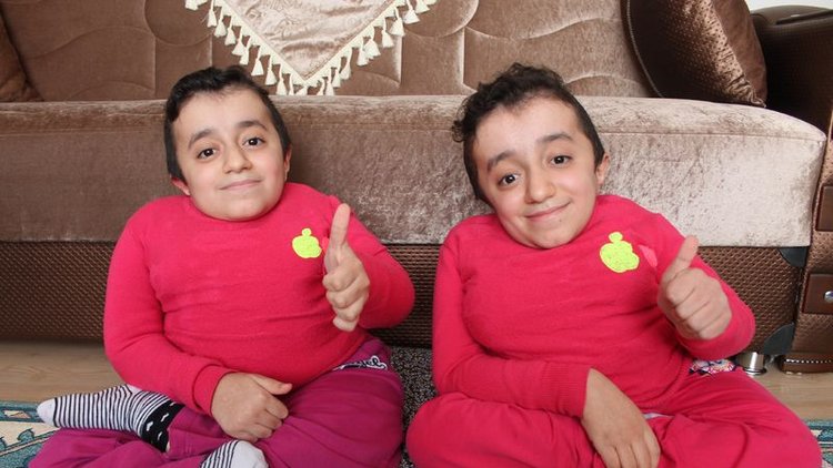 Cam kemik hastası, ikizler "Birinin kemiği kırılınca diğeri de hissediyor"