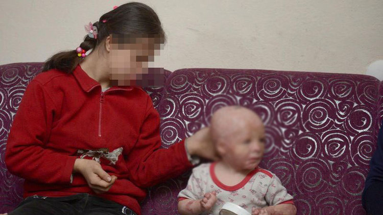 11 kez ameliyat oldu