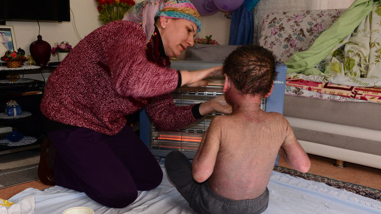 Hiç durmadan kaşınan çocuğun feryadı duyuldu... Sağlık Bakanlığı devreye girdi