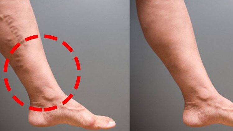 Varisle ilgili Doğru bilinen Yanlışlar